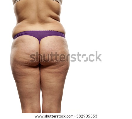 cellulitis buttocks #10