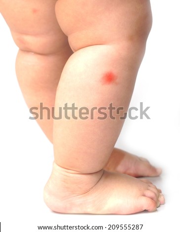 Red Spots On My Legs - Skin Cancer Forum - eHealthForum