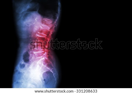 thesis on essential hypertension thesis on essential hypertension