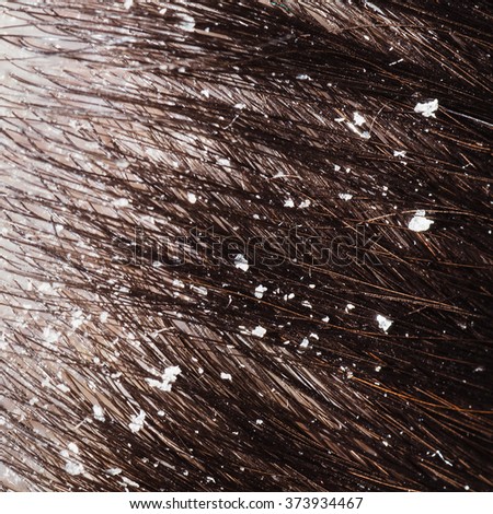 Clip Art Pictures Of Flaky Dandruff 61