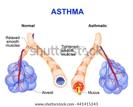 acute bronchitis contagious length