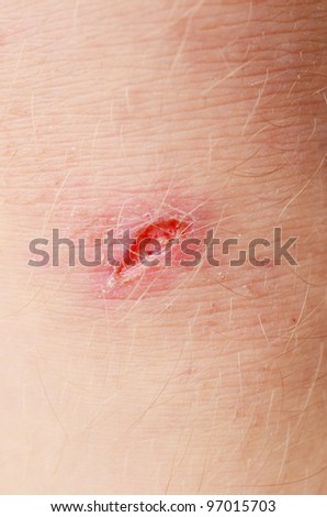 scar on human skin stock photo 209491861 cut skin stock photos images pictures scar on human skin stock photo 209491861 cut skin stock photos images pictures