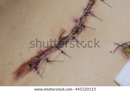 stock images similar to id 108133865 stitches on arm after stock images similar to id 88152760 a doctor removes blue suture stock images similar to id 108133865 stitches on arm after stock images similar to id 88152760 a doctor removes blue suture