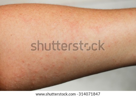 Allergic Stock Photos, Images, & Pictures | Shutterstock