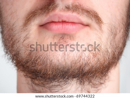 Herpes Labialis Stock Photos, Images, & Pictures | Shutterstock