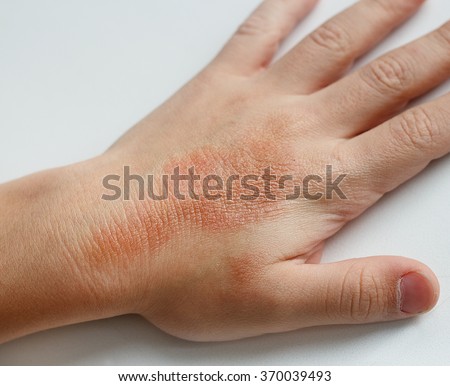 Eczema Stock Photos, Images, & Pictures | Shutterstock