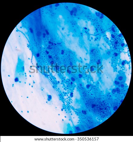 Sputum Stock Photos, Images, & Pictures | Shutterstock