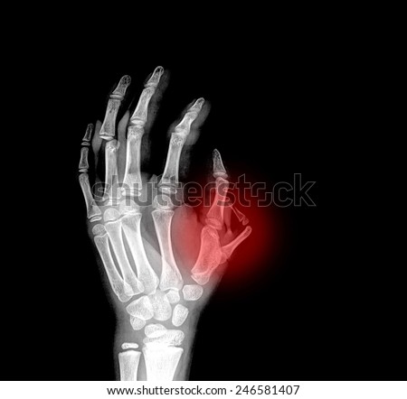 xray abnormal finger from the side, black background - stock photo