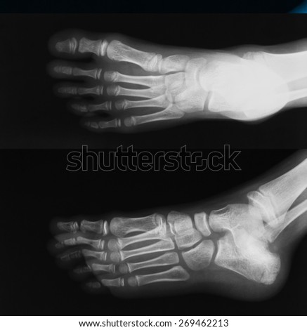 X-ray image of foot, AP and oblique view, show fracture of calcneus and ...