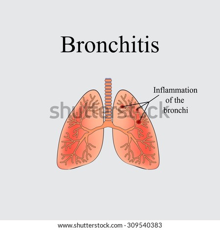 Bronchitis. The anatomical structure of the human lung. Vector ...