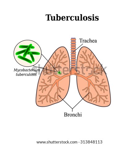 Tuberculosis Stock Photos, Images, & Pictures | Shutterstock