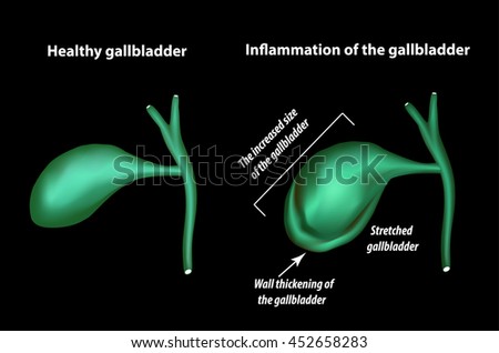 Gallbladder Stock Photos, Images, & Pictures | Shutterstock