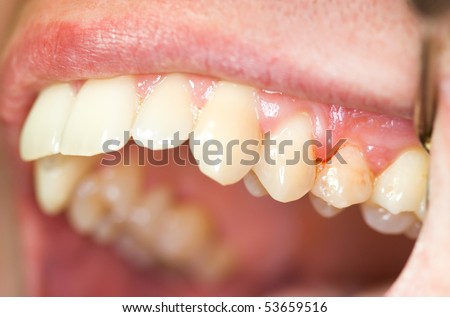 Gingivitis Stock Photos, Images, & Pictures | Shutterstock