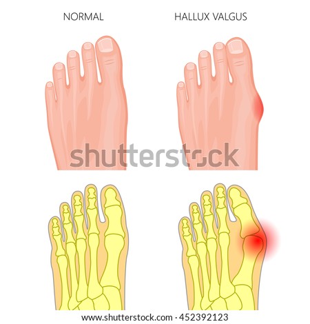 Metatarsal Stock Photos, Images, & Pictures | Shutterstock