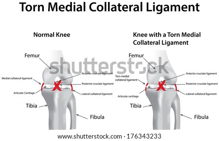 Medial Collateral Ligament Stock Photos, Images, & Pictures | Shutterstock