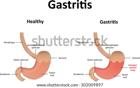 Oesophagus Stock Photos, Images, & Pictures | Shutterstock