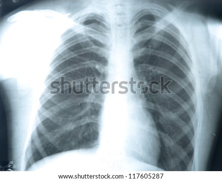 Photofluorography