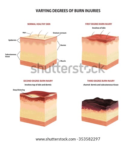 Skin Burn Stock Photos, Images, & Pictures | Shutterstock